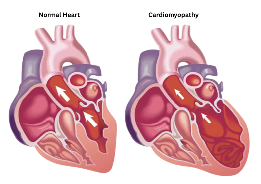 Cardiomyopathy