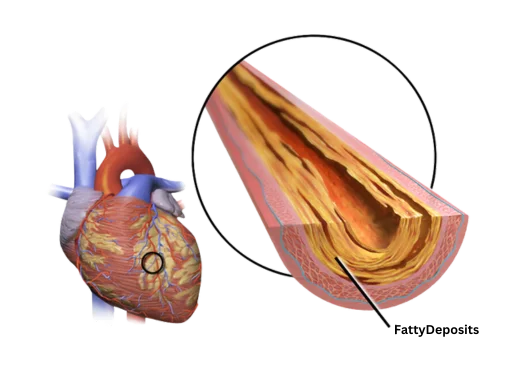Coronary Artery Disease