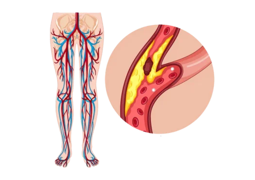 Peripheral Arterial Disease