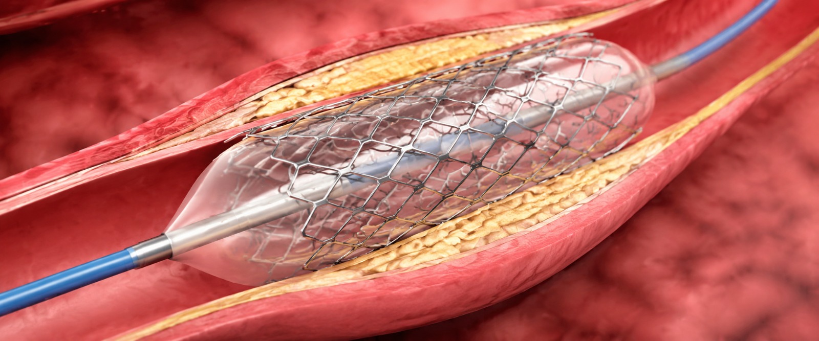 Illustration of an irregular, racing heartbeat