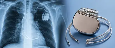 Pacemaker device beside a chest X-ray showing the leads