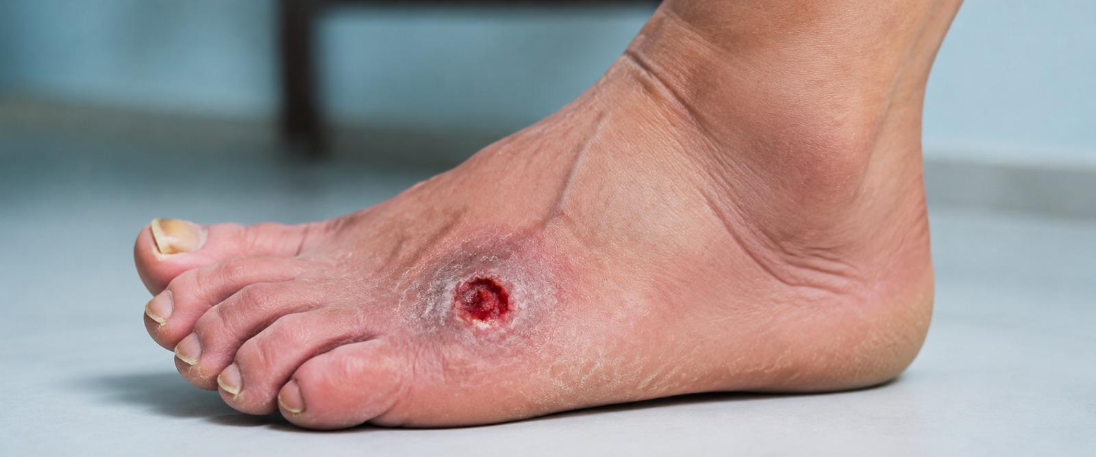 Slow-healing sore on the toes being examined